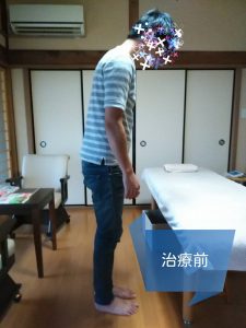 腰痛の治療前